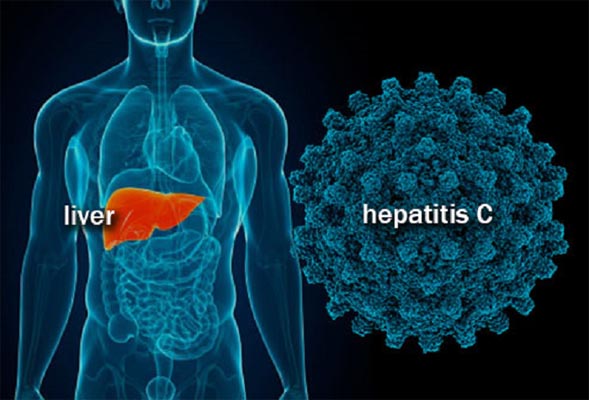 Sofosbuvir in Treating HCV