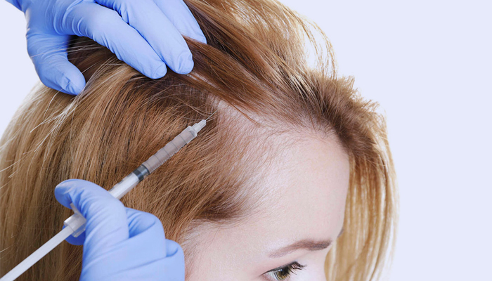Reasons to Get Hair Transplant