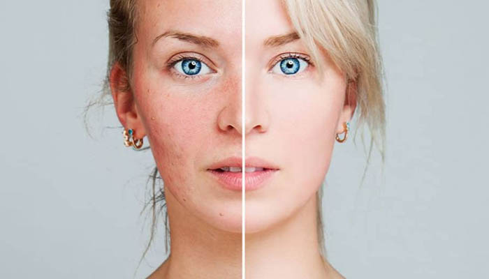acne skin Facial prone