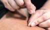 Acupuncture Treatment For Psoriatic Arthritis
