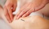 Acupuncture Treatment For Varicose Veins