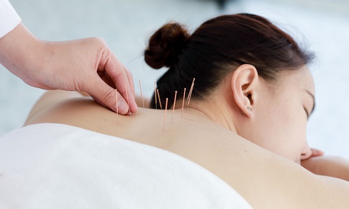 Benefits of Acupuncture