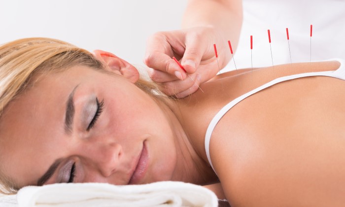 acupuncture for back pain