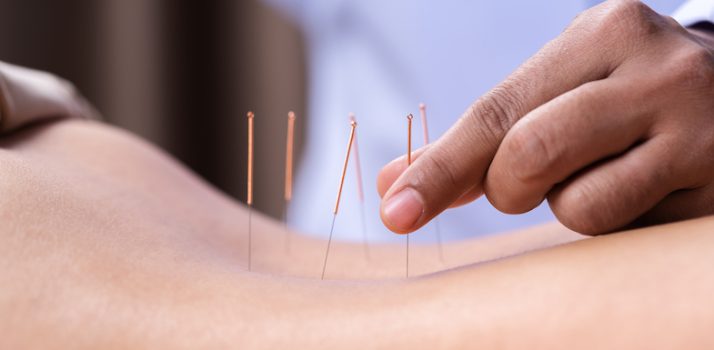 acupuncture to relieve pain