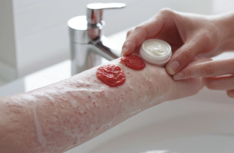 Eczema Cream Recommended By Dermatologists