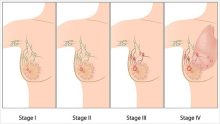 Know the Importance of Discerning and Attending To Breast Cancer Stages