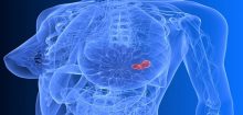 Knowing the Breast Cancer Symptoms Beside Lump